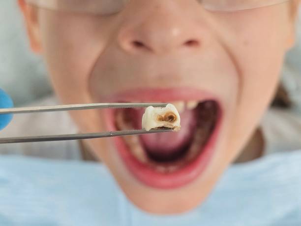 Best Knocked-Out Tooth (Avulsed Tooth) Treatment in Pewee Valley, KY