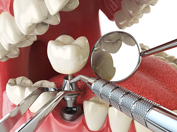 Best Broken or Chipped Tooth Repair in Pewee Valley, KY